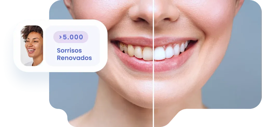 Clareamento Caseiro