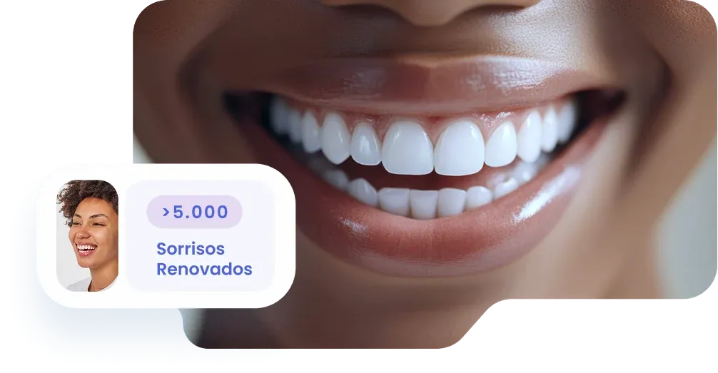 Facetas Laminadas