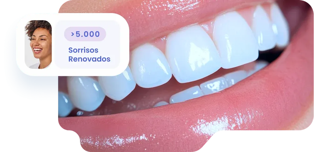 Lente de Contato Dental
