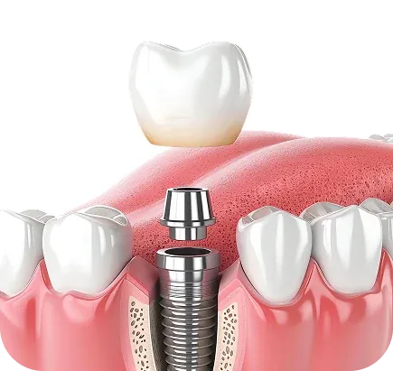 Prótese Dentária