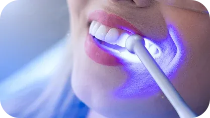Clareamento Dental a Laser