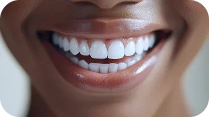 Facetas Laminadas