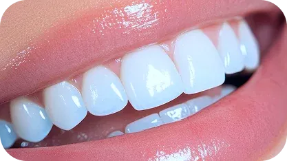 Lente de Contato Dental
